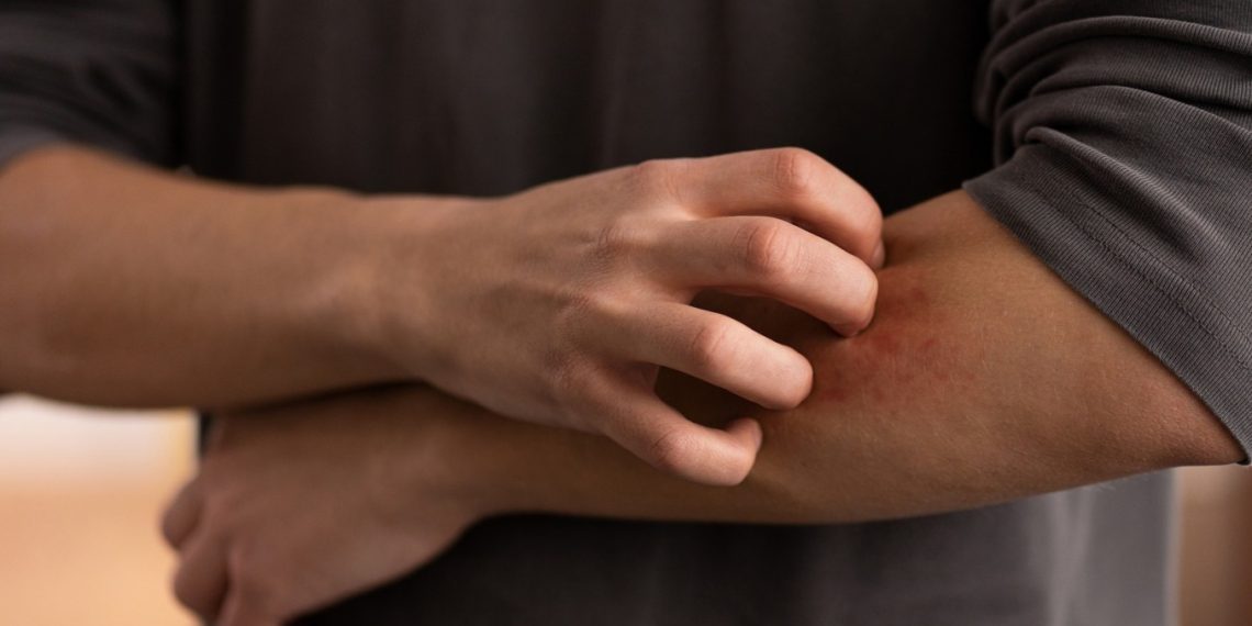pessoa com dermatite se coçando