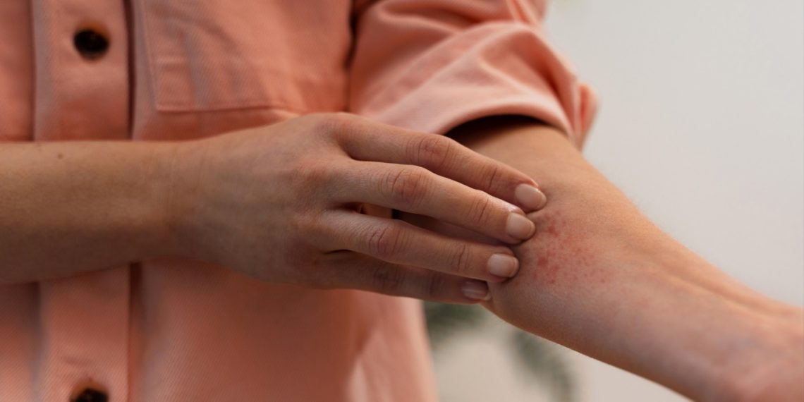 O que fazer quando a coceira começa?