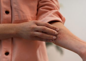 O que fazer quando a coceira começa?