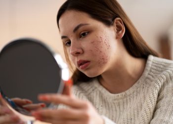 Cinco verdades sobre espinhas que você precisa saber