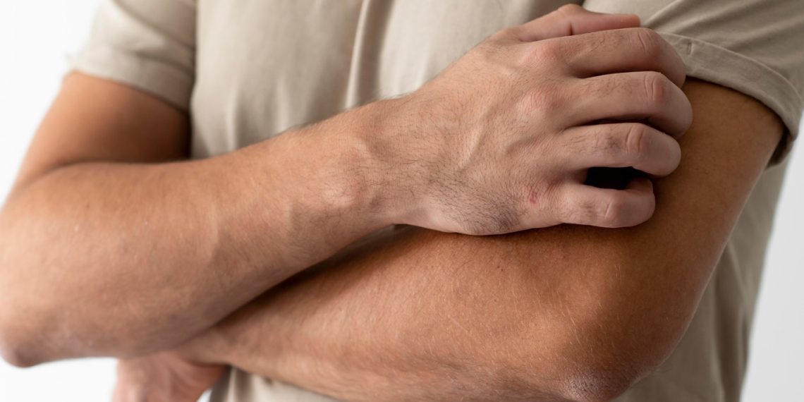 coceira na dobra dos braços