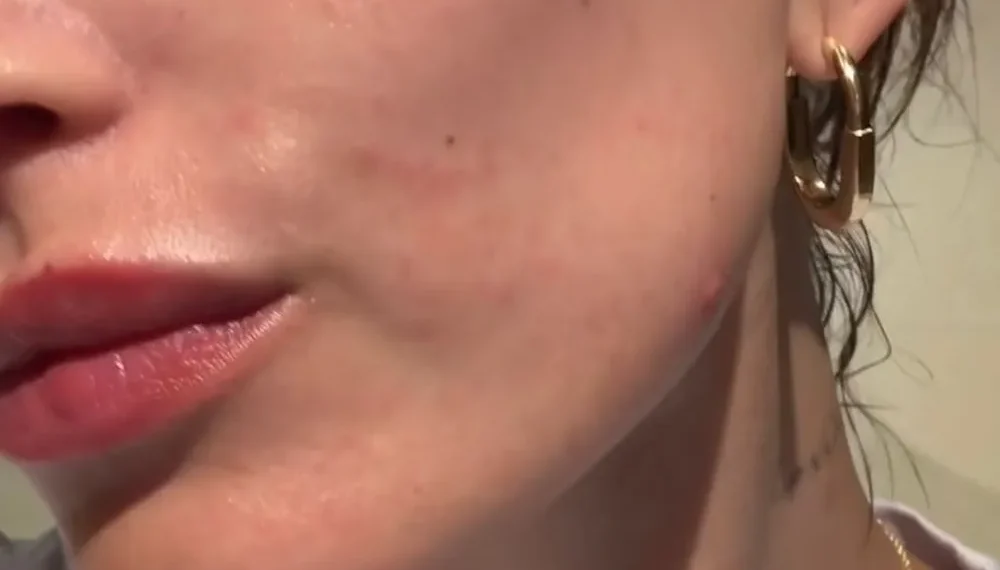 Hailey Bieber mostra pele com dermatite perioral — Foto: TikTok