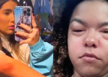 Alergia alimentar e emocional ‘queima a pele’ e vitimam famosas
