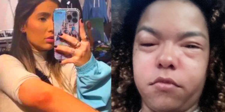 Alergia alimentar e emocional ‘queima a pele’ e vitimam famosas