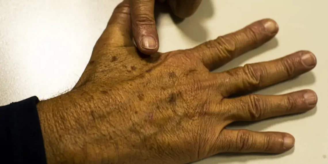 cancer_de_pele_melanoma20220520_0621