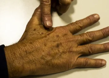 cancer_de_pele_melanoma20220520_0621