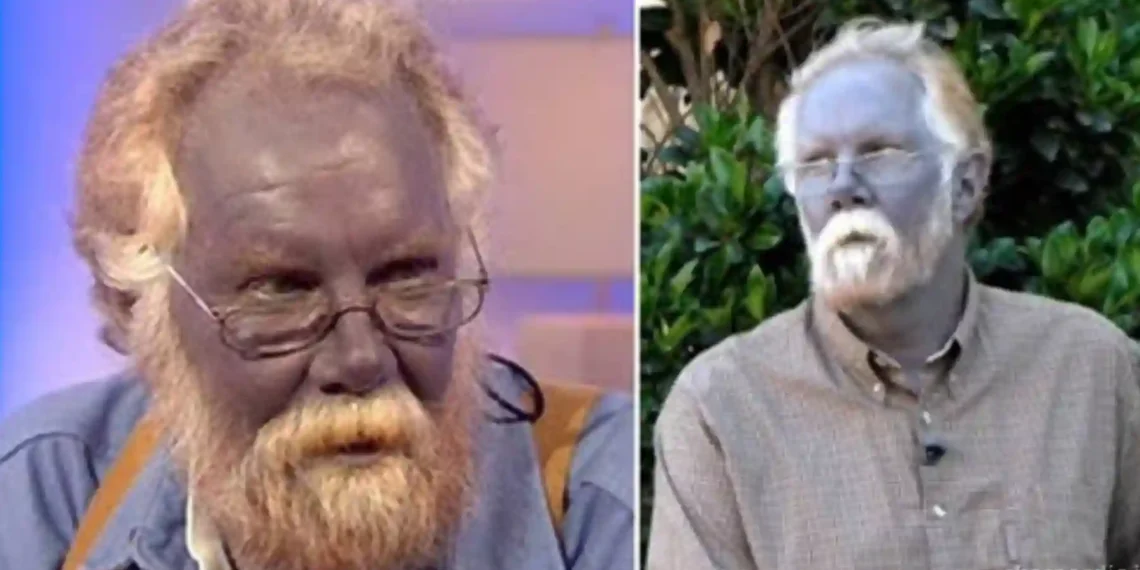 Argiria - doença rara que deixa a pele azul. Foto: Reprodução