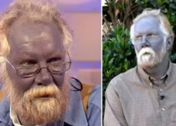 Argiria - doença rara que deixa a pele azul. Foto: Reprodução