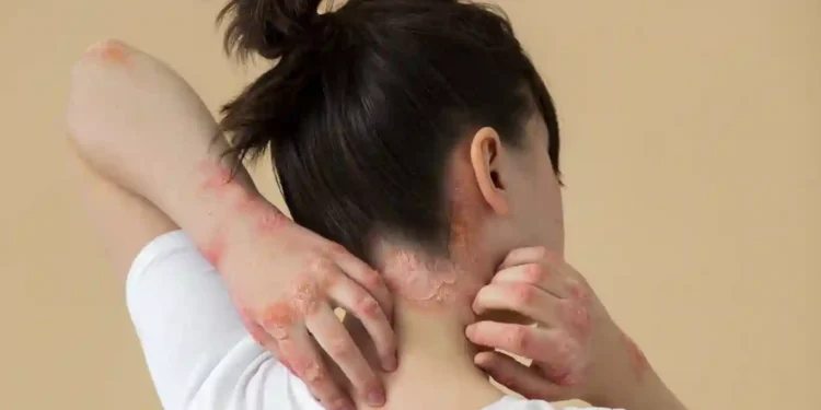 Coceira nas costas. Foto: Freepik