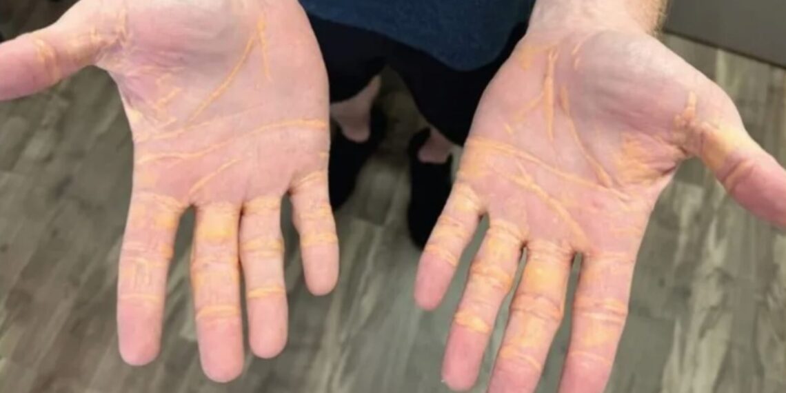 Homem ‘vaza’ colesterol pela pele com dieta rica em gordura