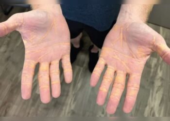 Homem ‘vaza’ colesterol pela pele com dieta rica em gordura